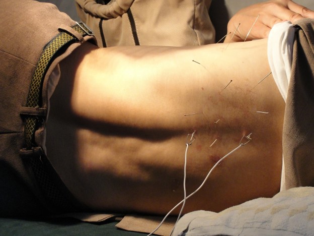 dry needling for hip flexor pain